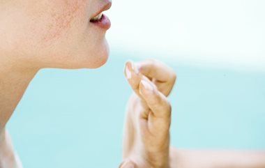 Side effects of acne treatment