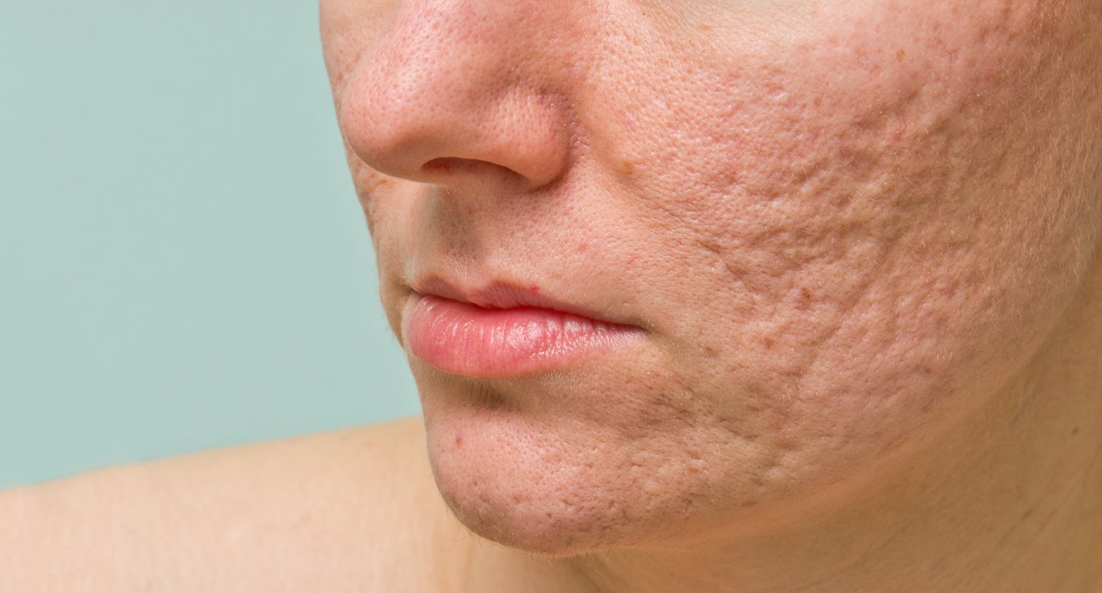 علامات حب الشباب الآثار الناتجة عن حب الشباب Eucerin
