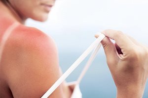 كيفية علاج الحروق